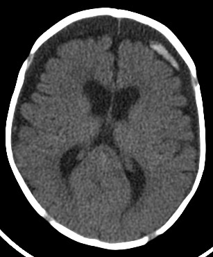 Ct+scan+brain+normal